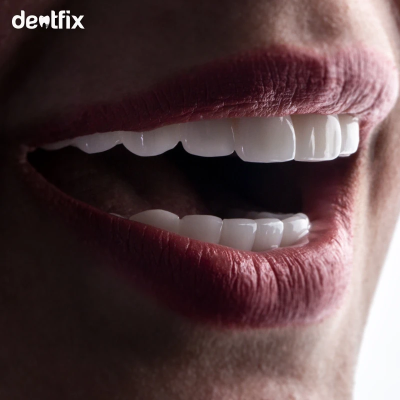 Veneers-Tuerkei.jpeg